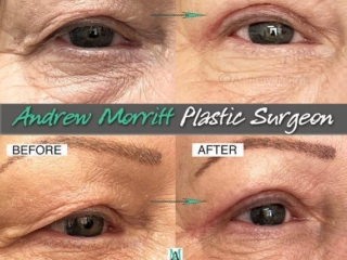 upper eyelid lift surgery