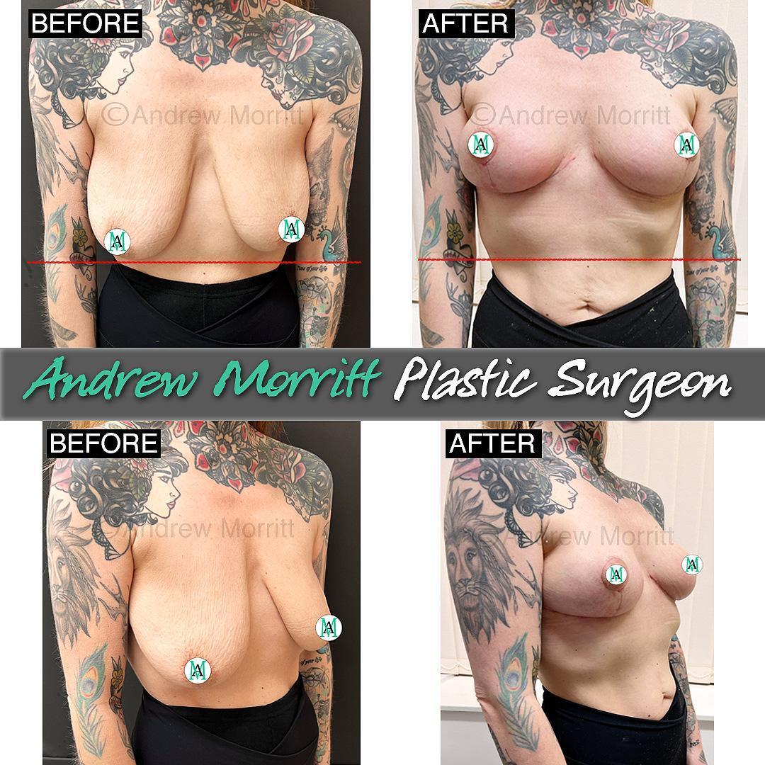 photos of breast lift mastopexy