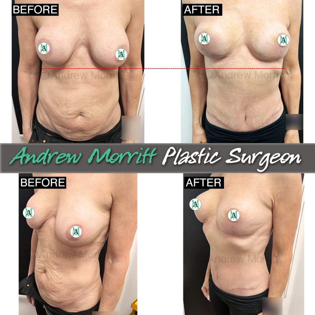 mummy makeover sheffield