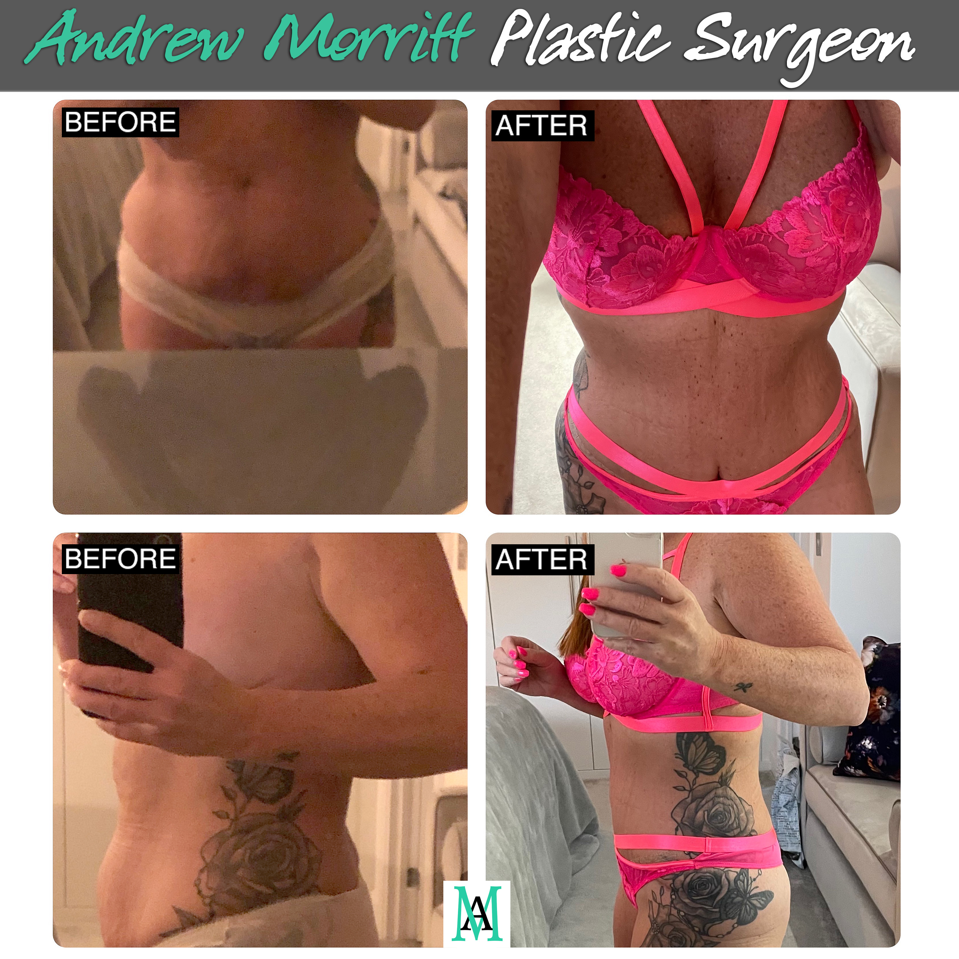 mummy makeover sheffield