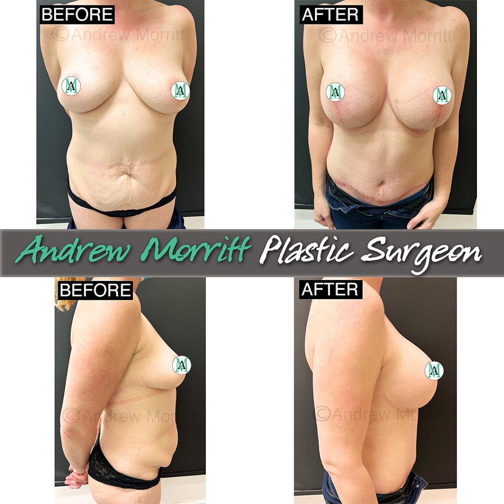 mummy makeover sheffield