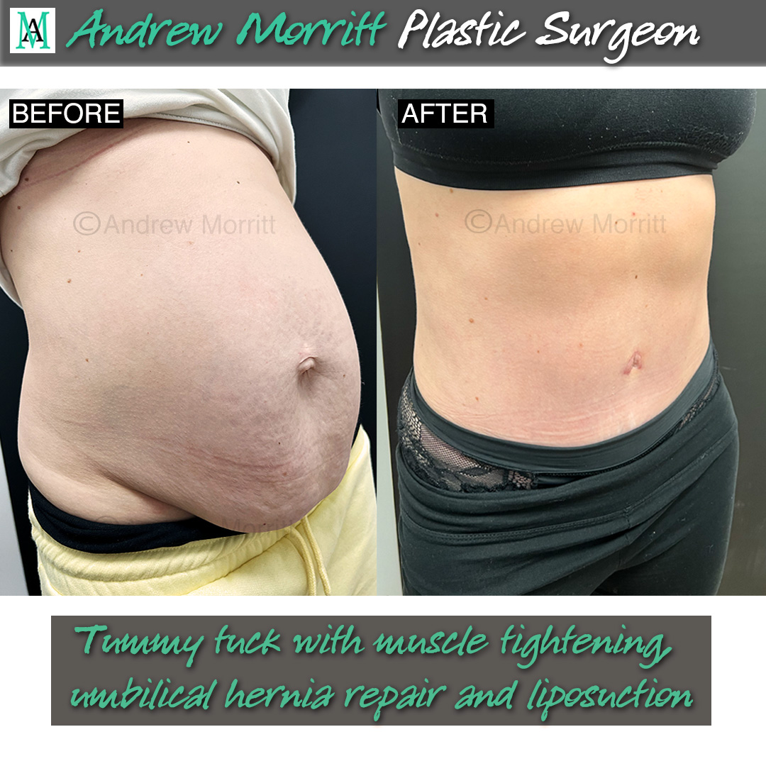 tummy tuck sheffield