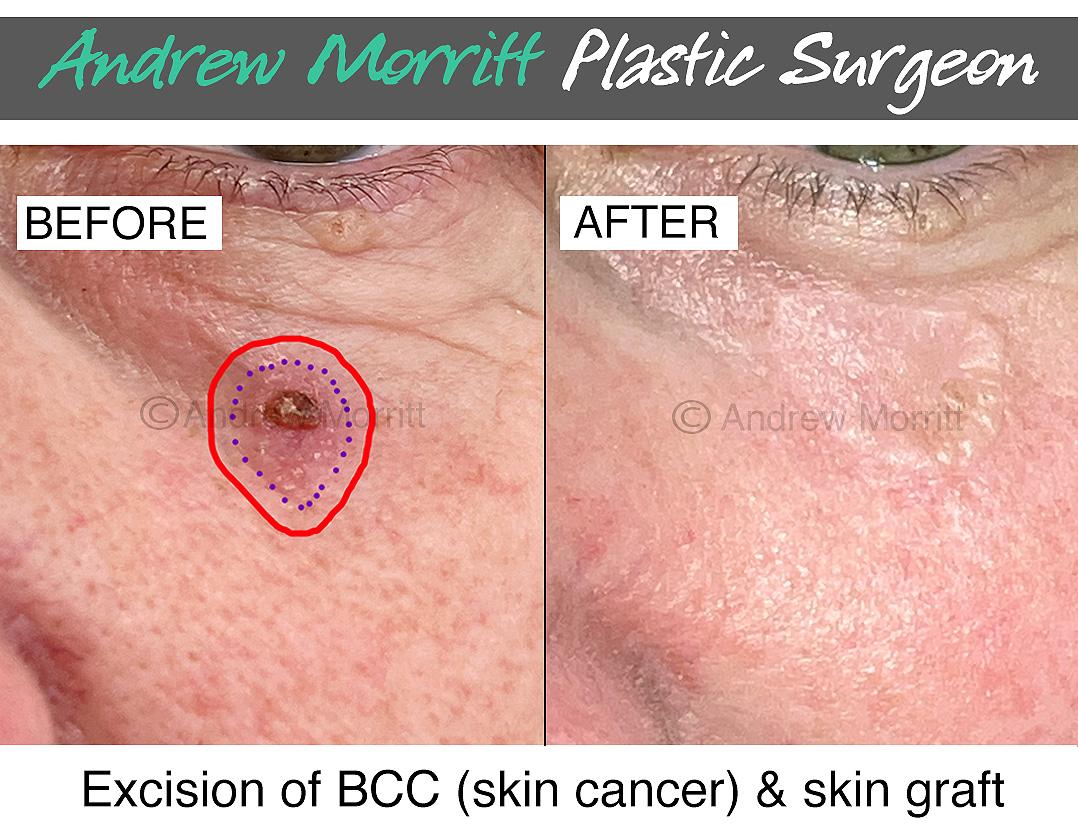 bcc skin cancer treatment sheffield