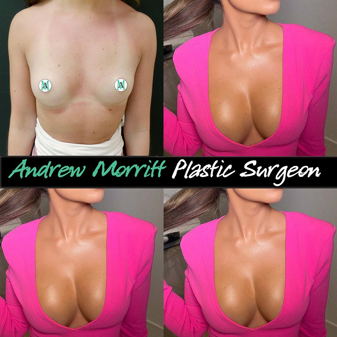 breast augmentation sheffield patient selfie