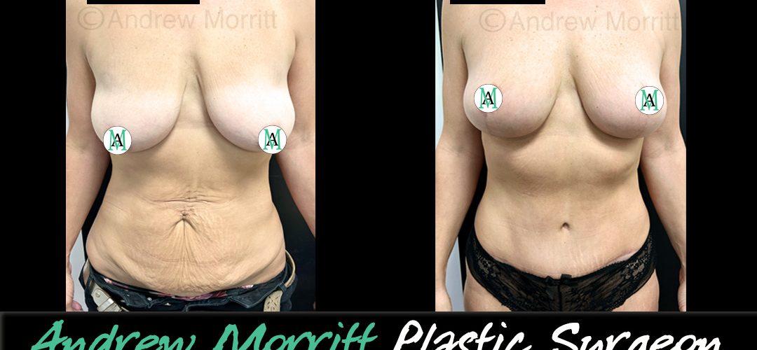 mummy makeover Sheffield