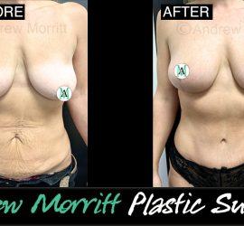 mummy makeover Sheffield