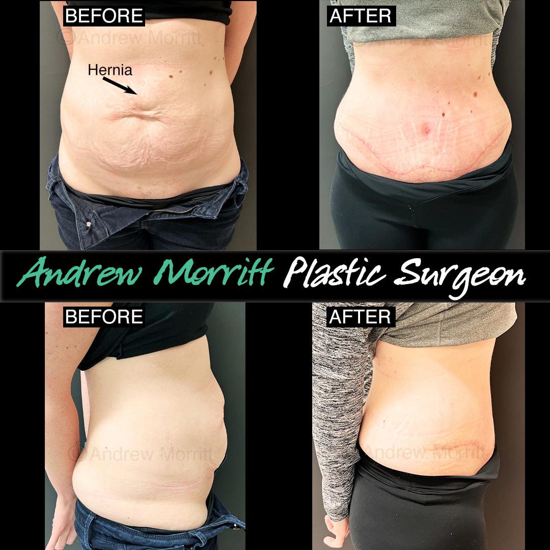 tummy tuck sheffield