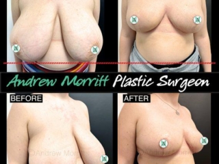 breast reduction sheffield