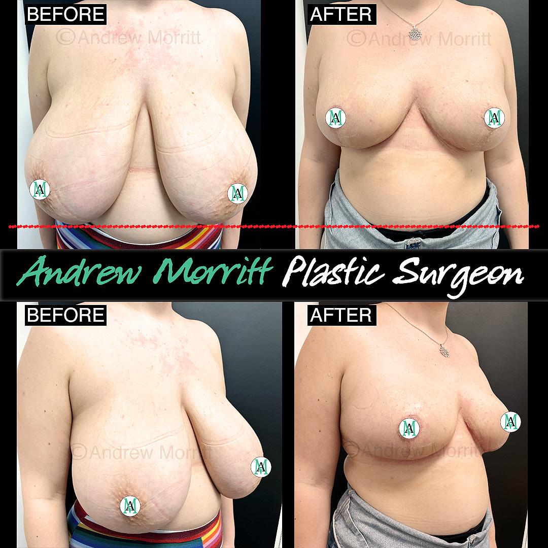 breast reduction sheffield