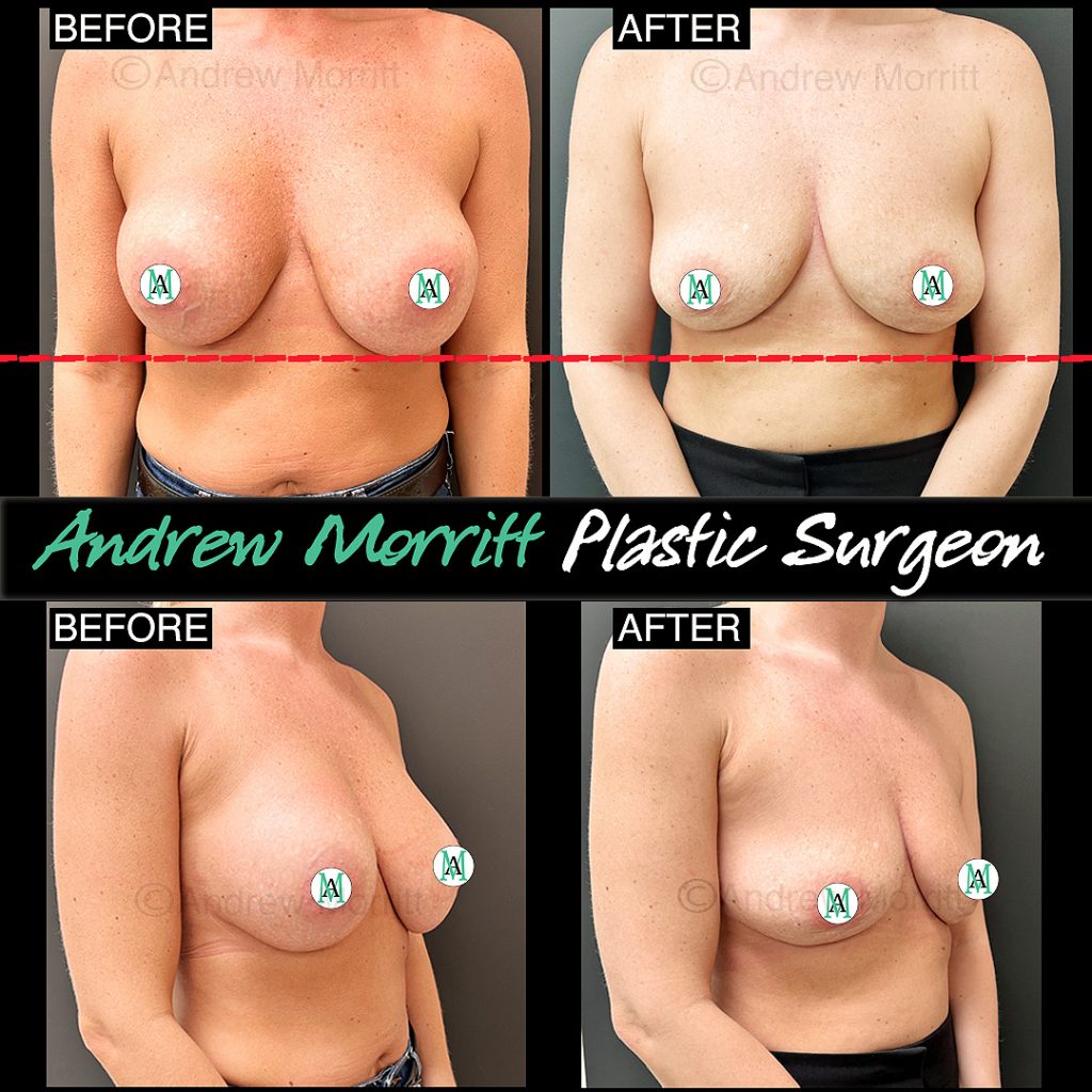 removal of breast implants and capsulectomy