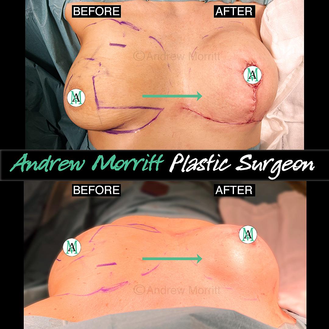 breast uplift lift mastopexy photos