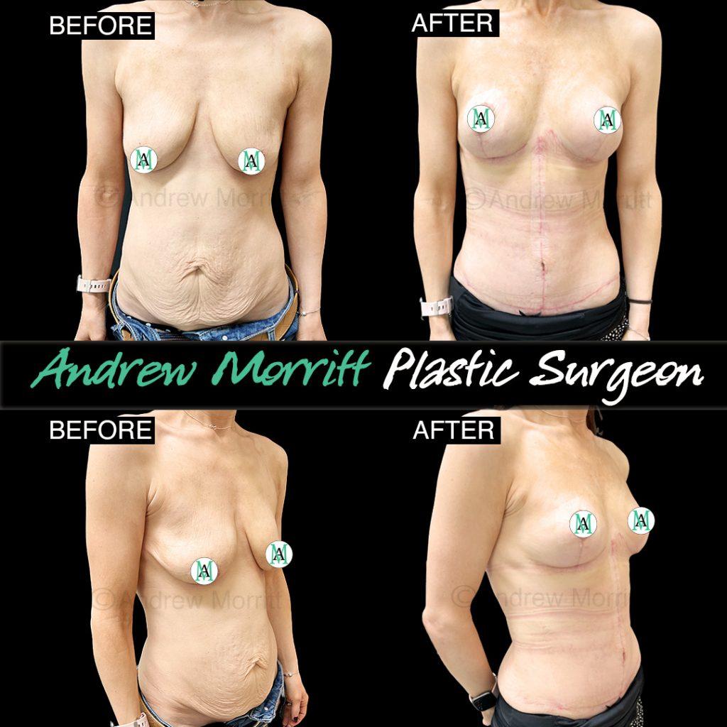 mummy makeover sheffield