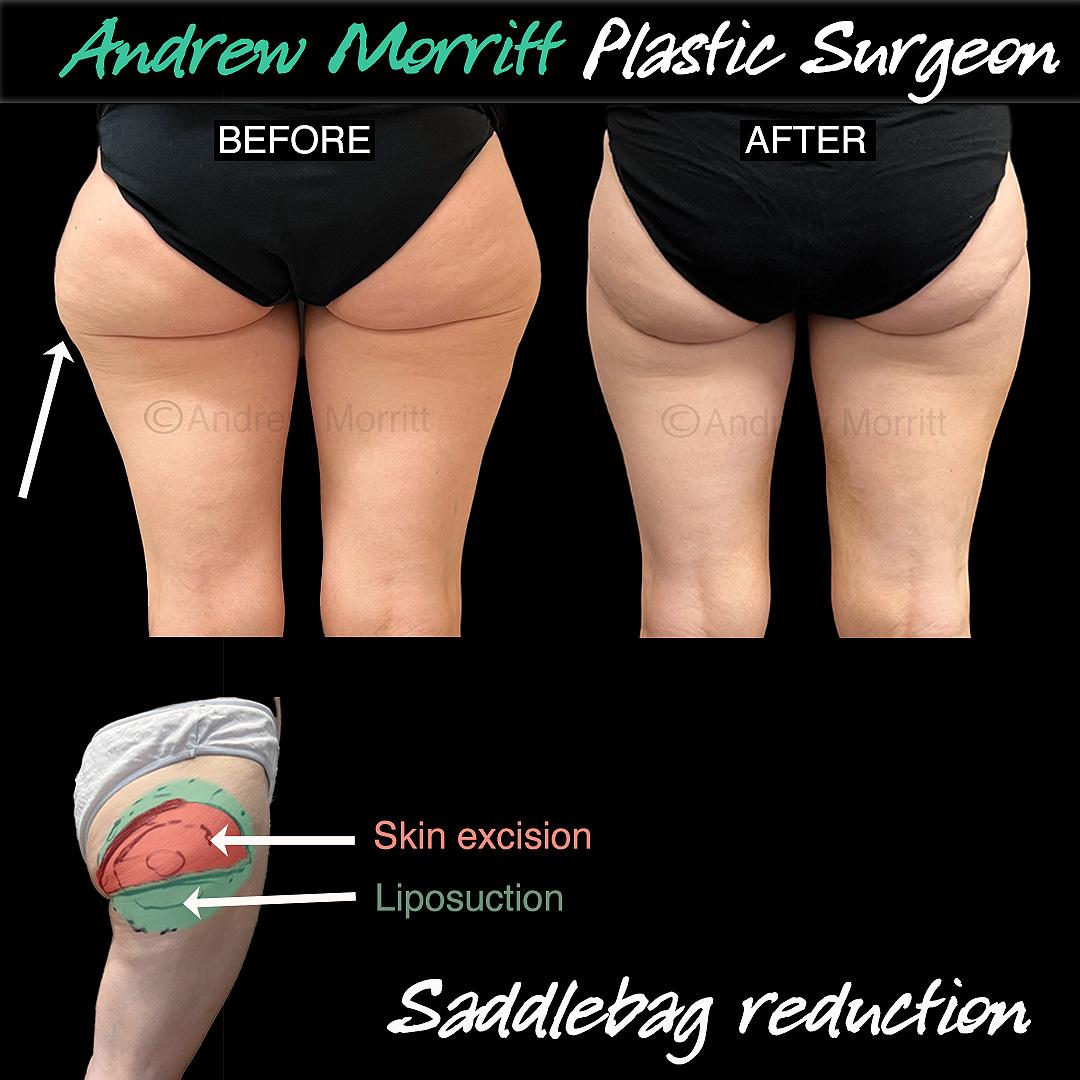 saddlebag reduction surgery