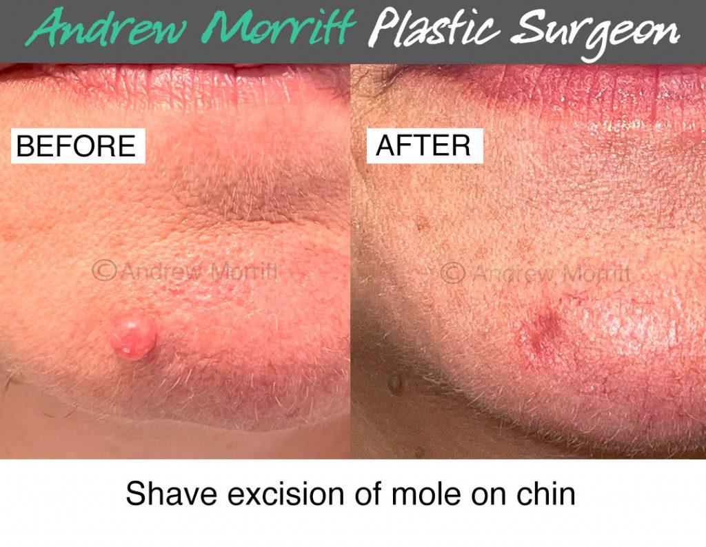 shave excision mole chin