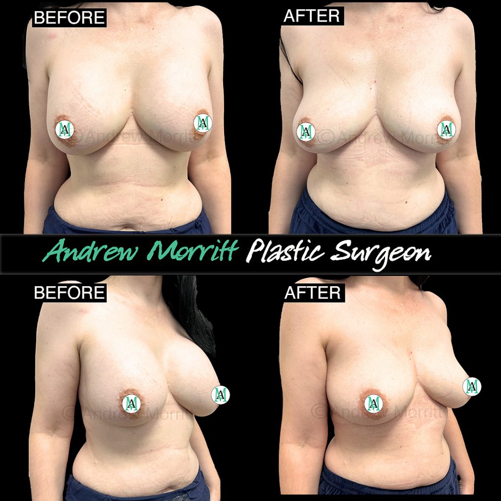 breast implant removal breast implant illness capsulectomy