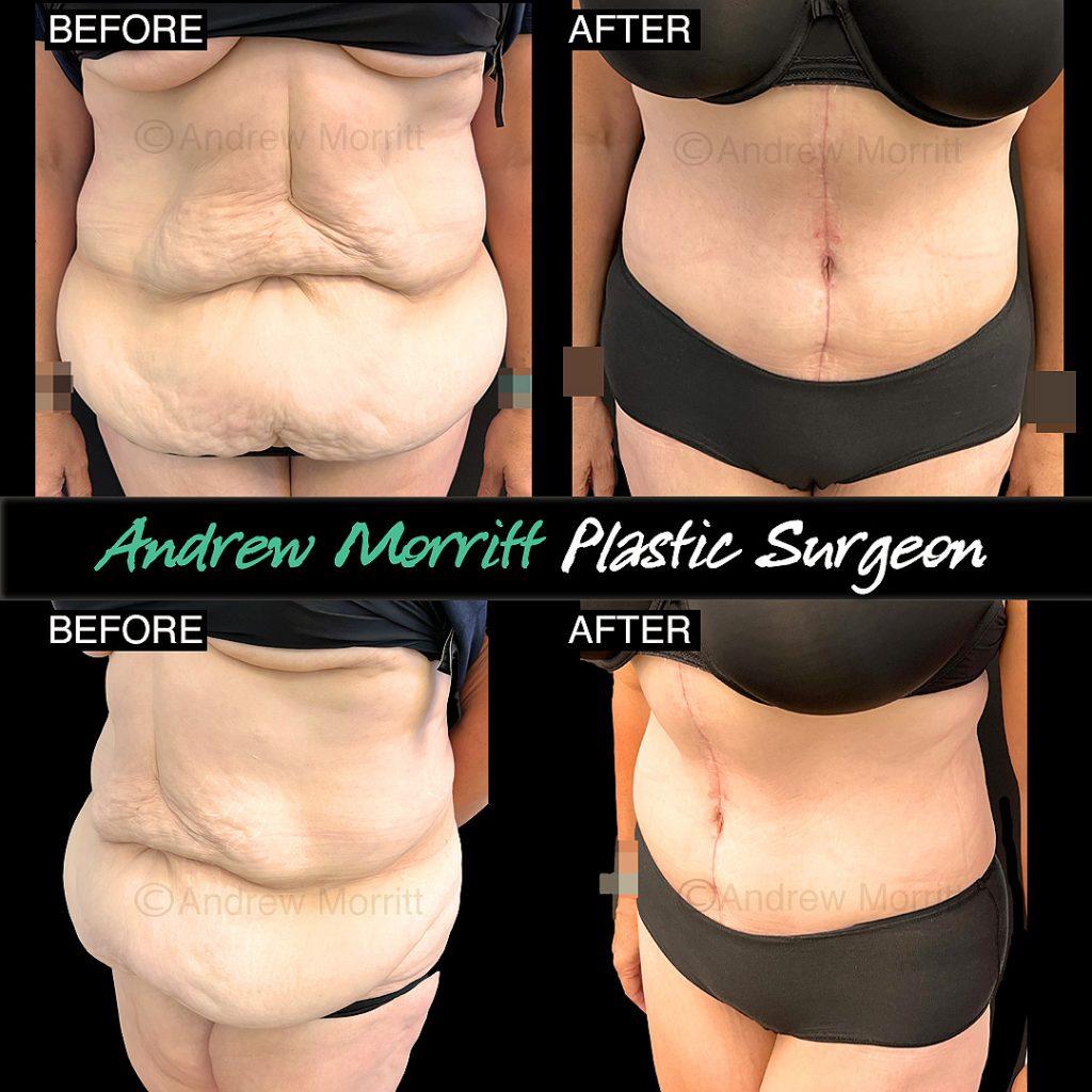 fleur de lys abdominoplasty