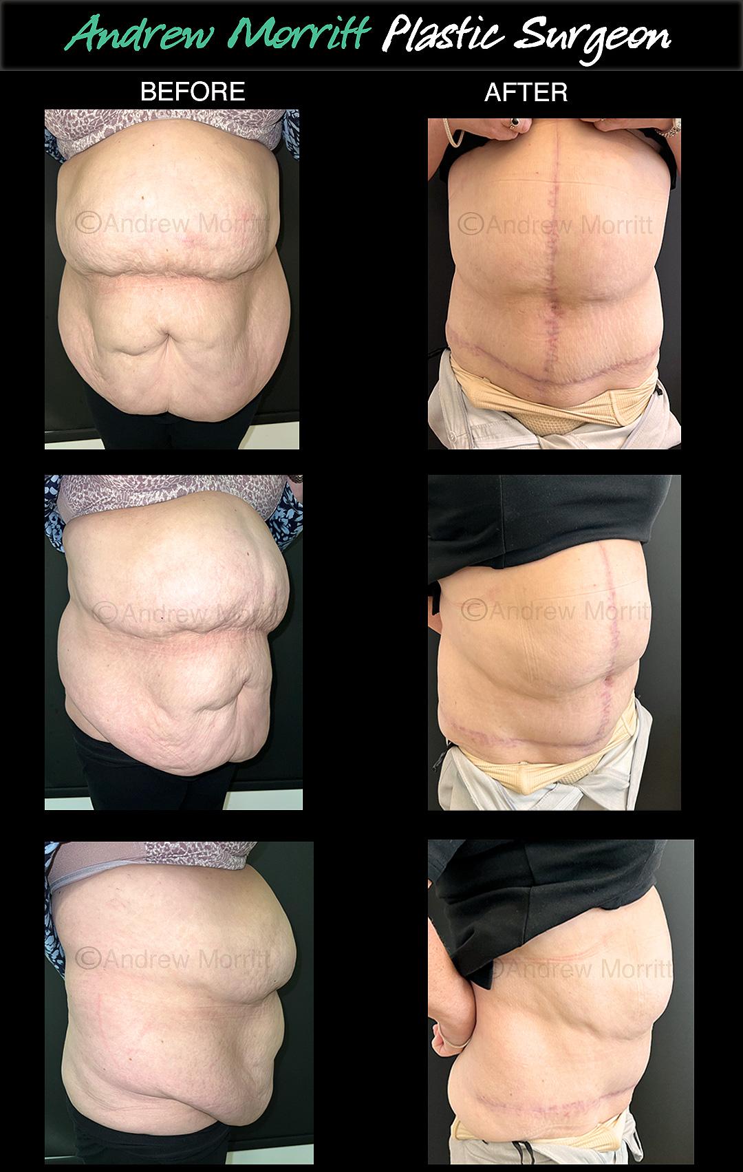 tummy tuck FDL