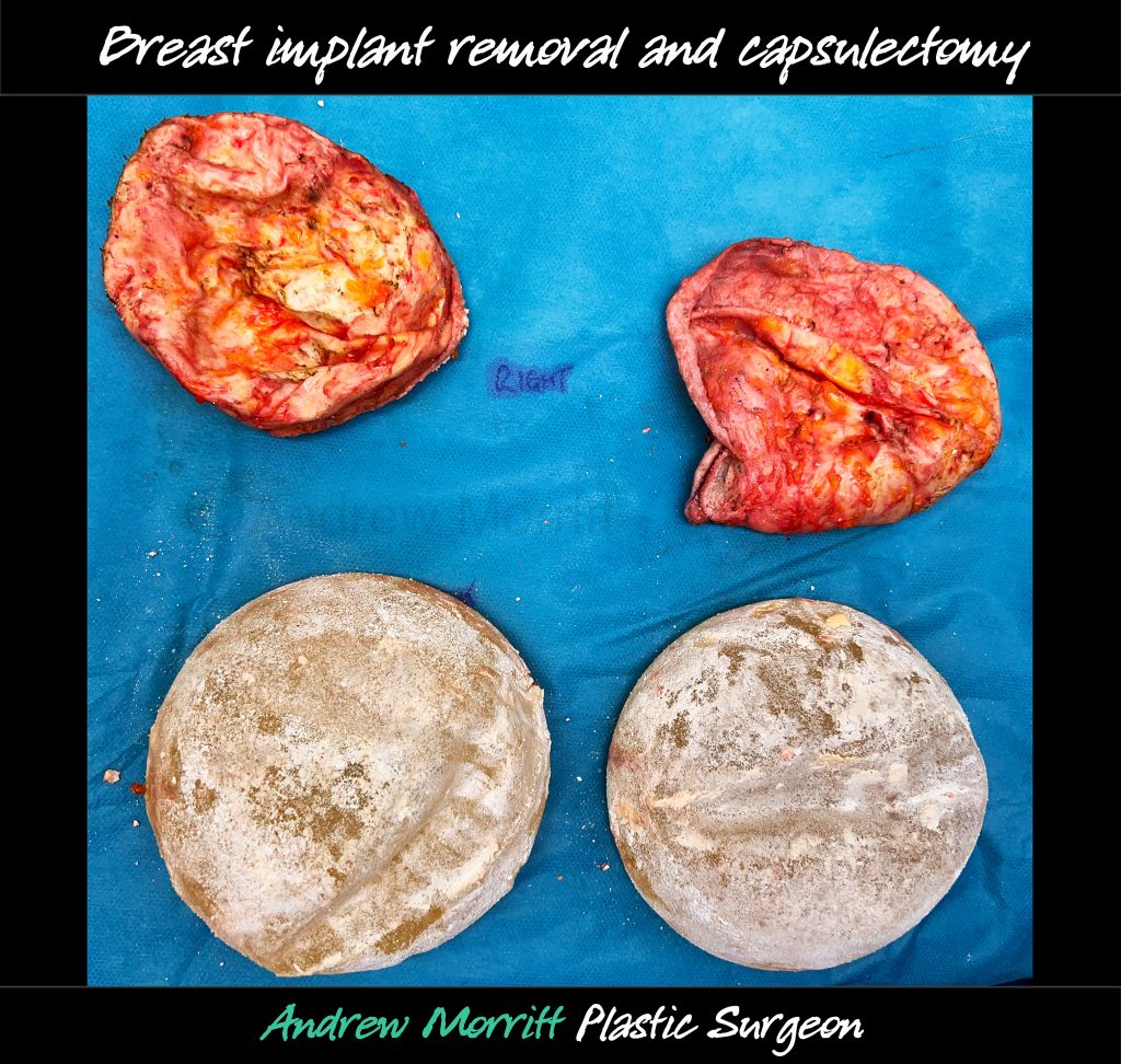 breast implant removal total capsulectomy