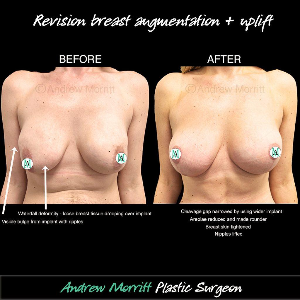 breast implant revision
