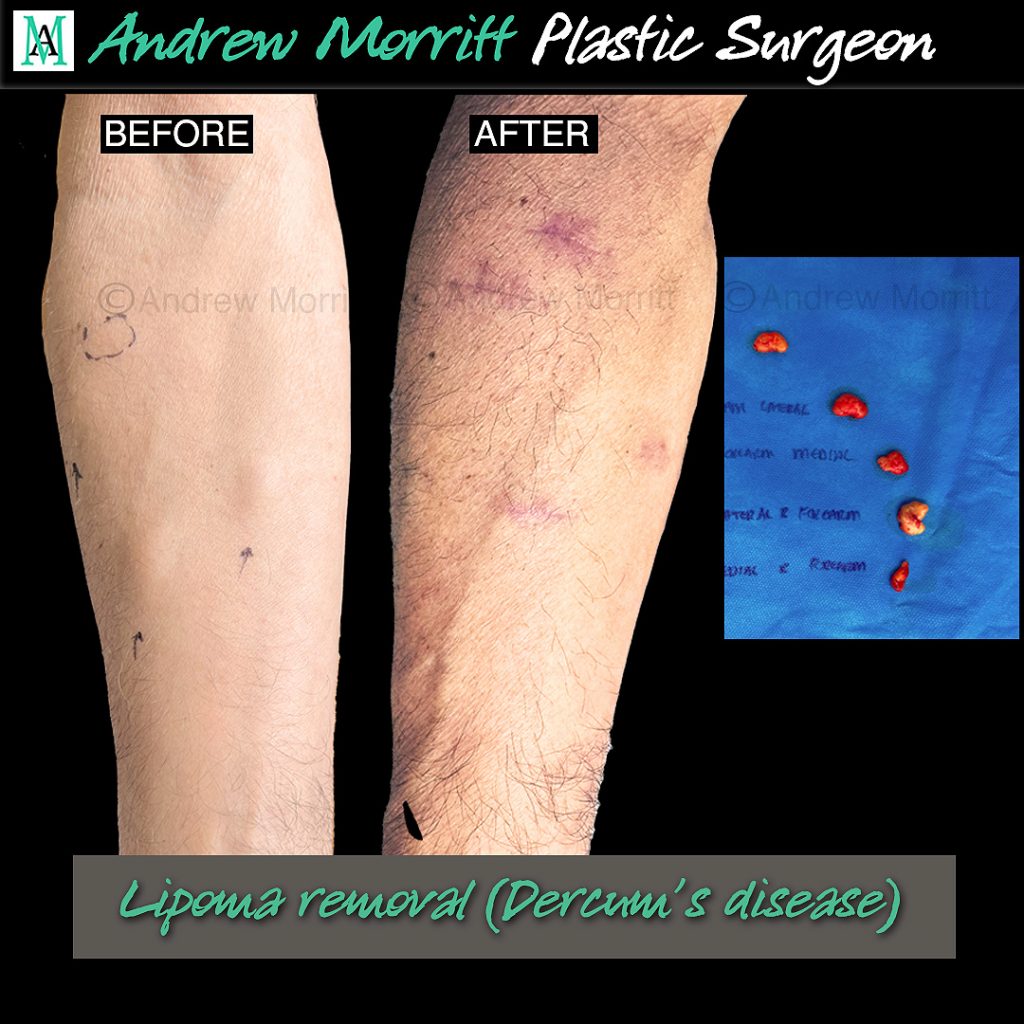 lipoma removal dercum's disease