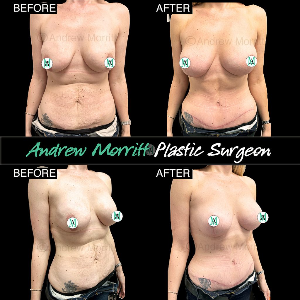 mummy makeover sheffield