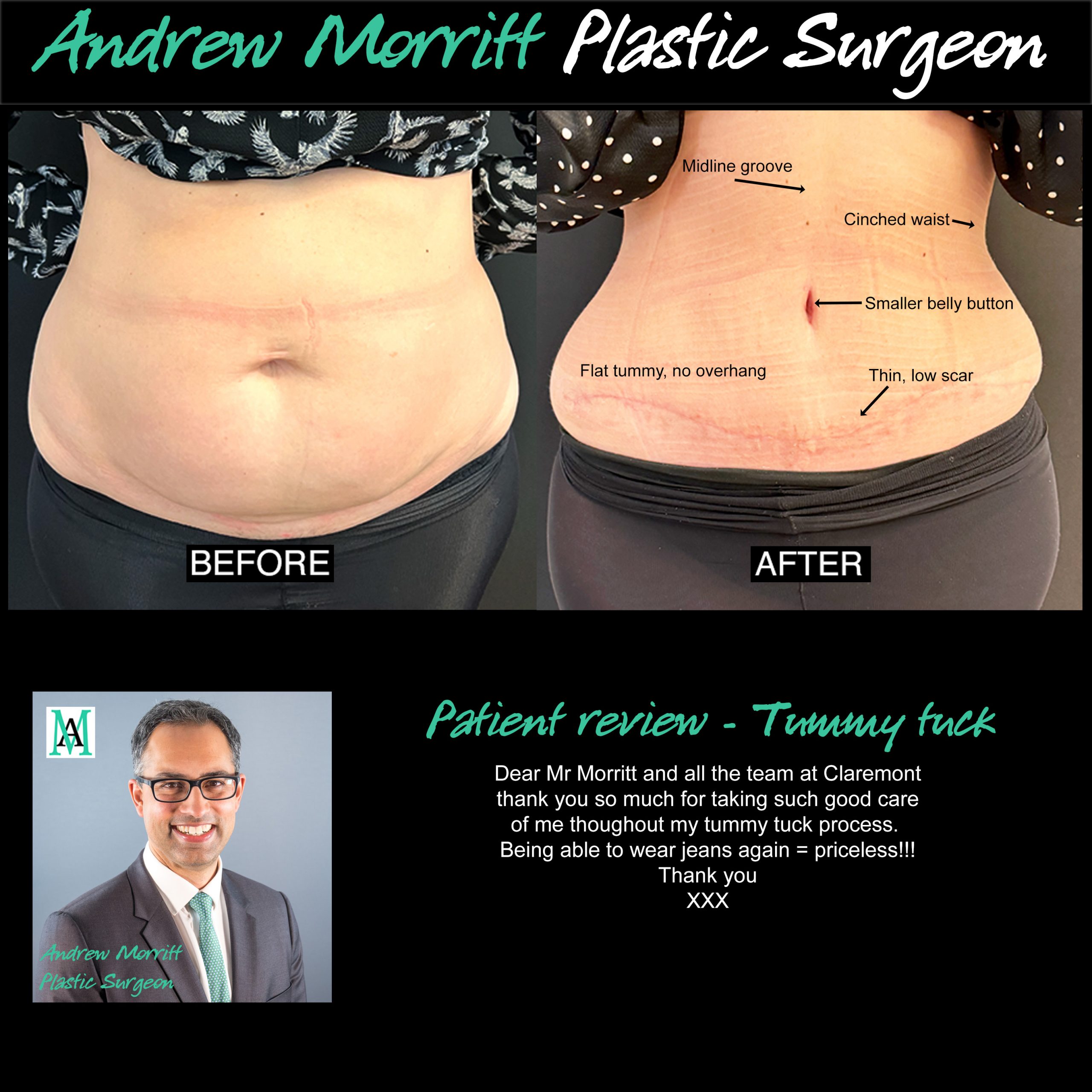 tummy tuck abdominoplasty