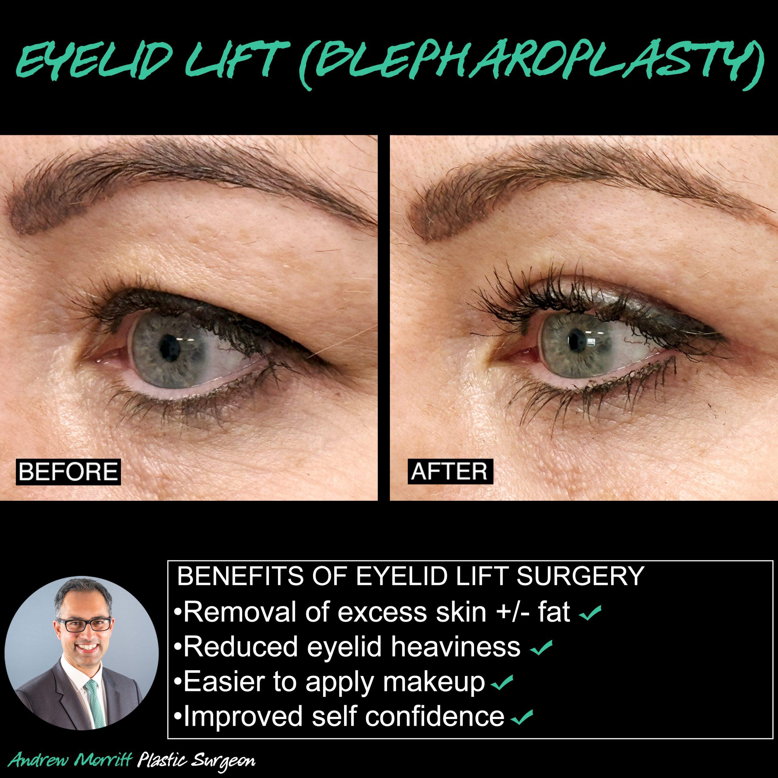 eyelid lift blepharoplasty