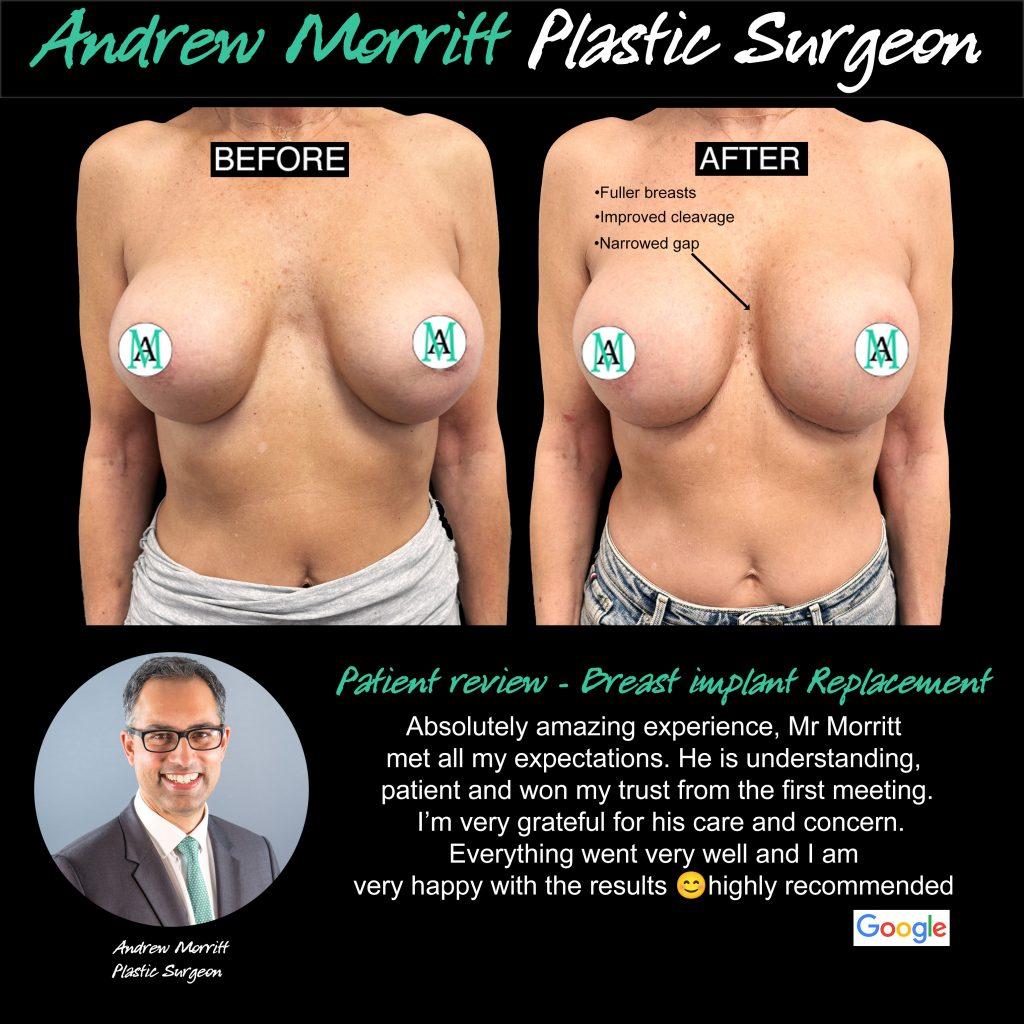 breast implant replacement