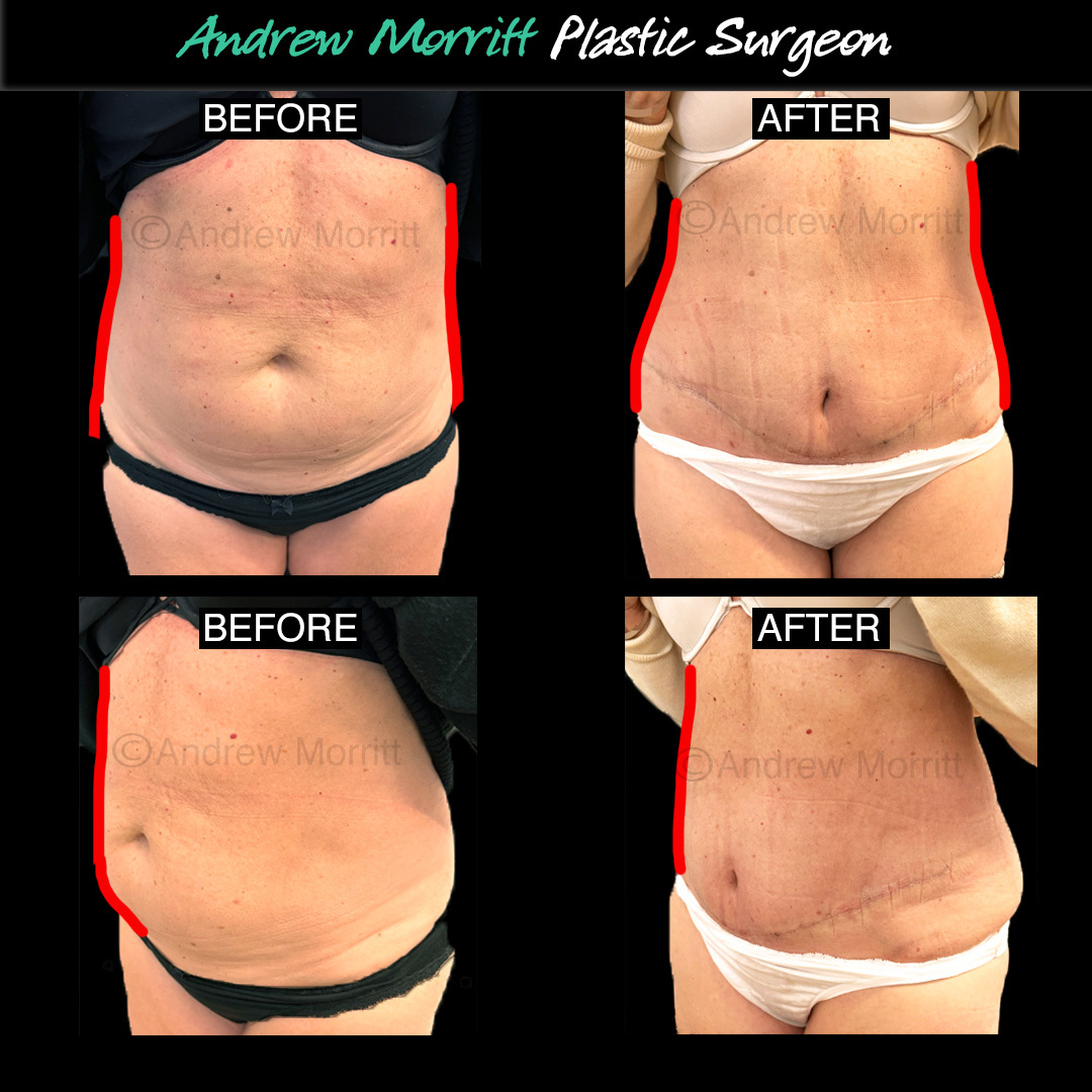 tummy tuck