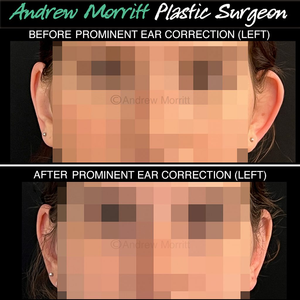 ear pinning prominent ear Sheffield