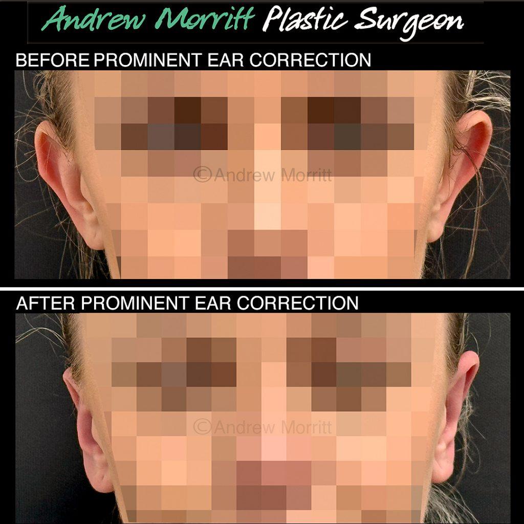 prominent ear correction Sheffield