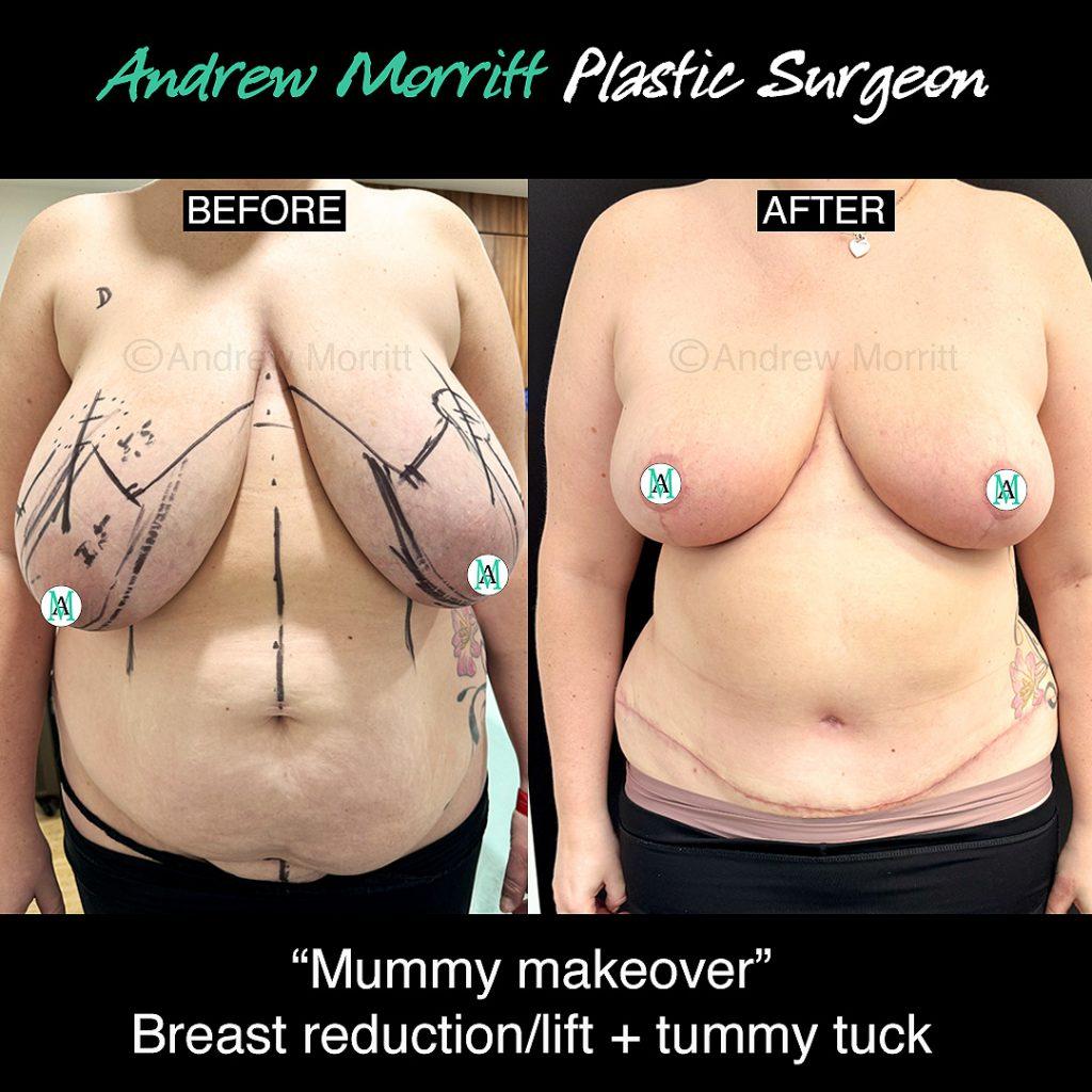 mummy makeover breast tummy surgery