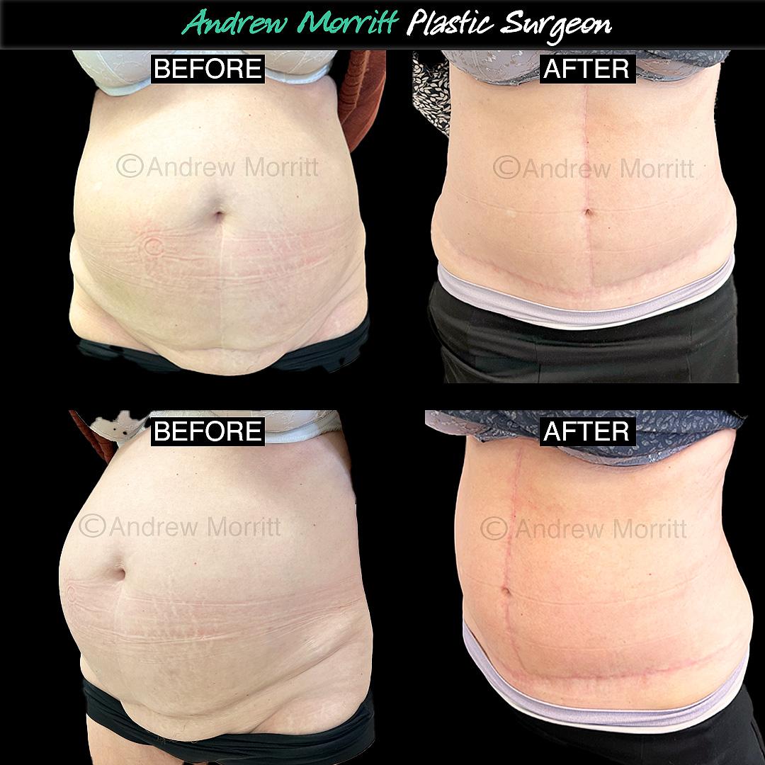 FDL tummy tuck fleur de lys