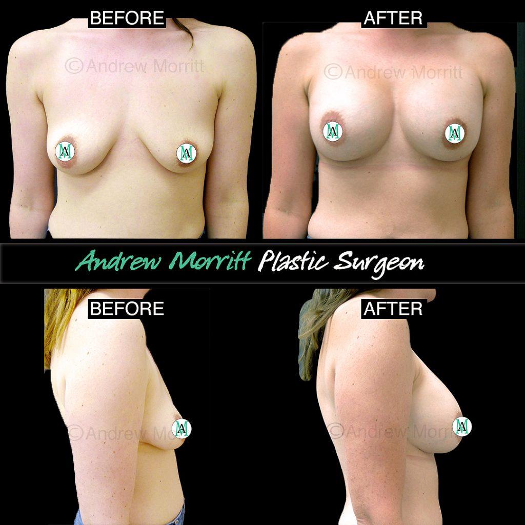 breast-augmentation-28 breast augmentation
