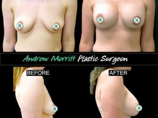 breast-augmentation-28 breast augmentation