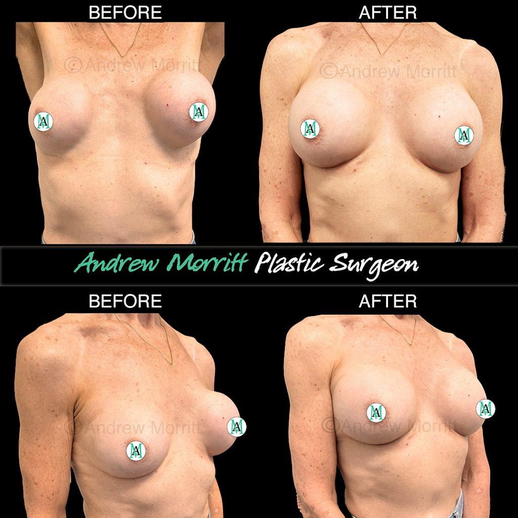 breast implant replacement