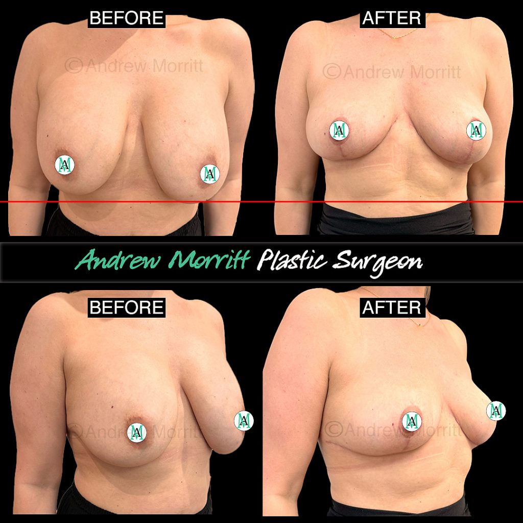 Allergan breast implant removal capsulectomy and uplift breast implant illness