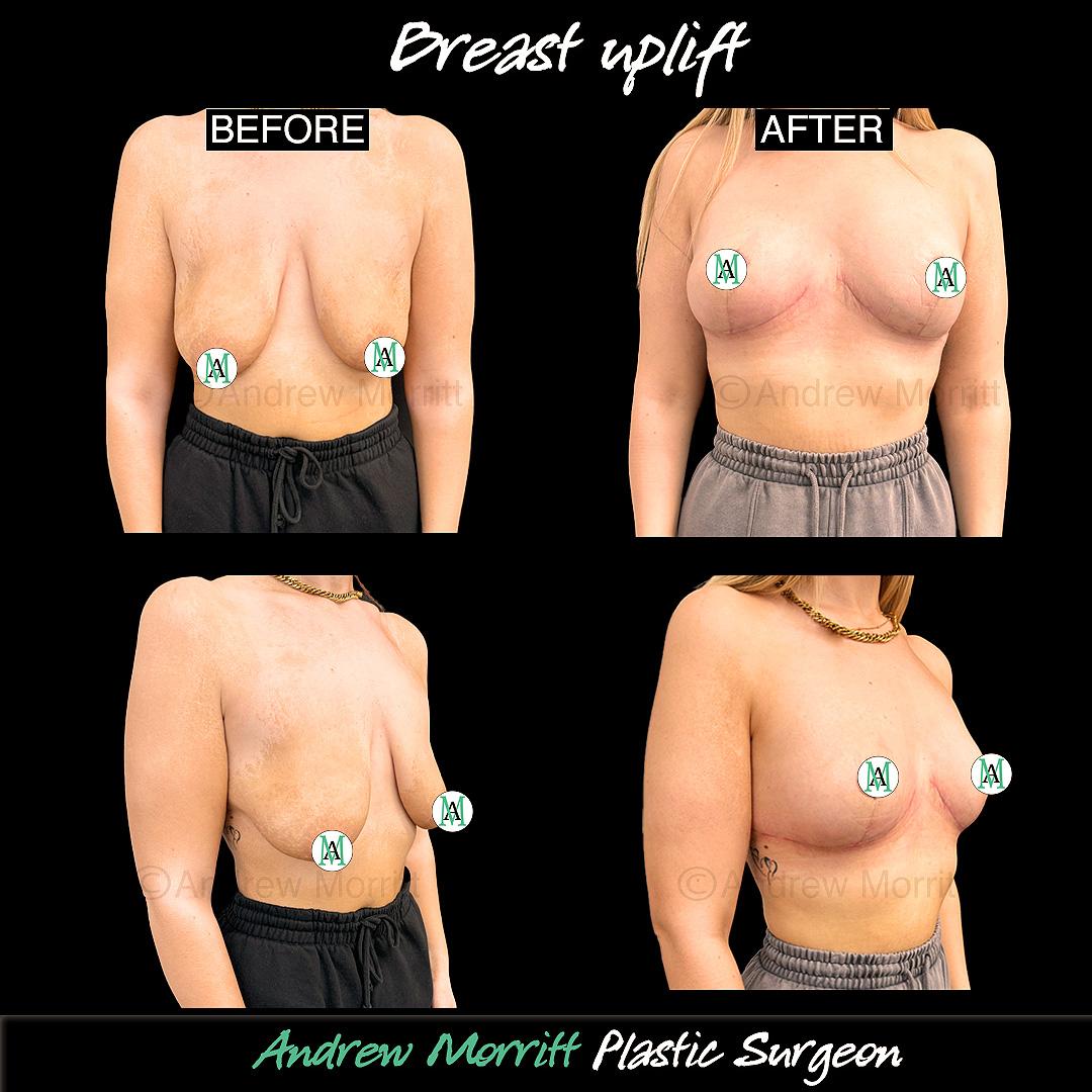 breast uplift mastopexy