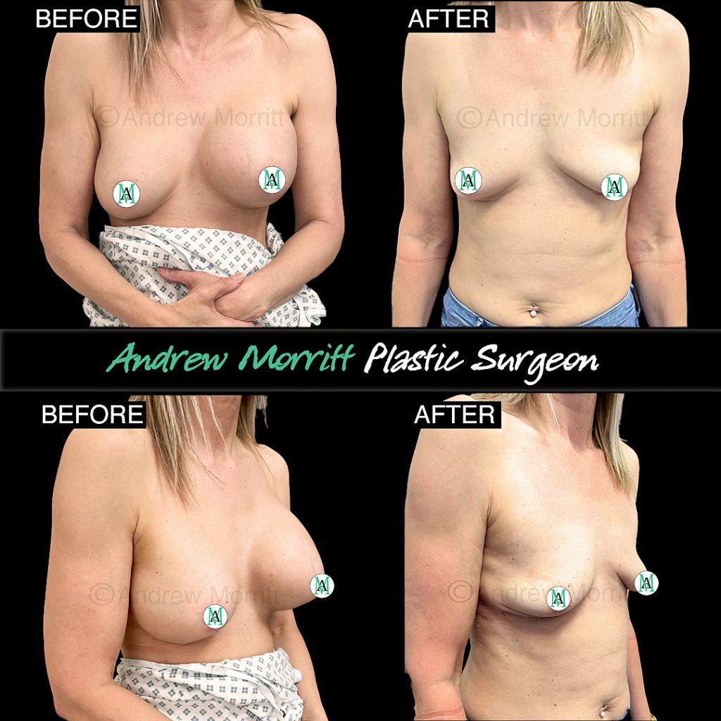 breast implant removal total capsulectomy