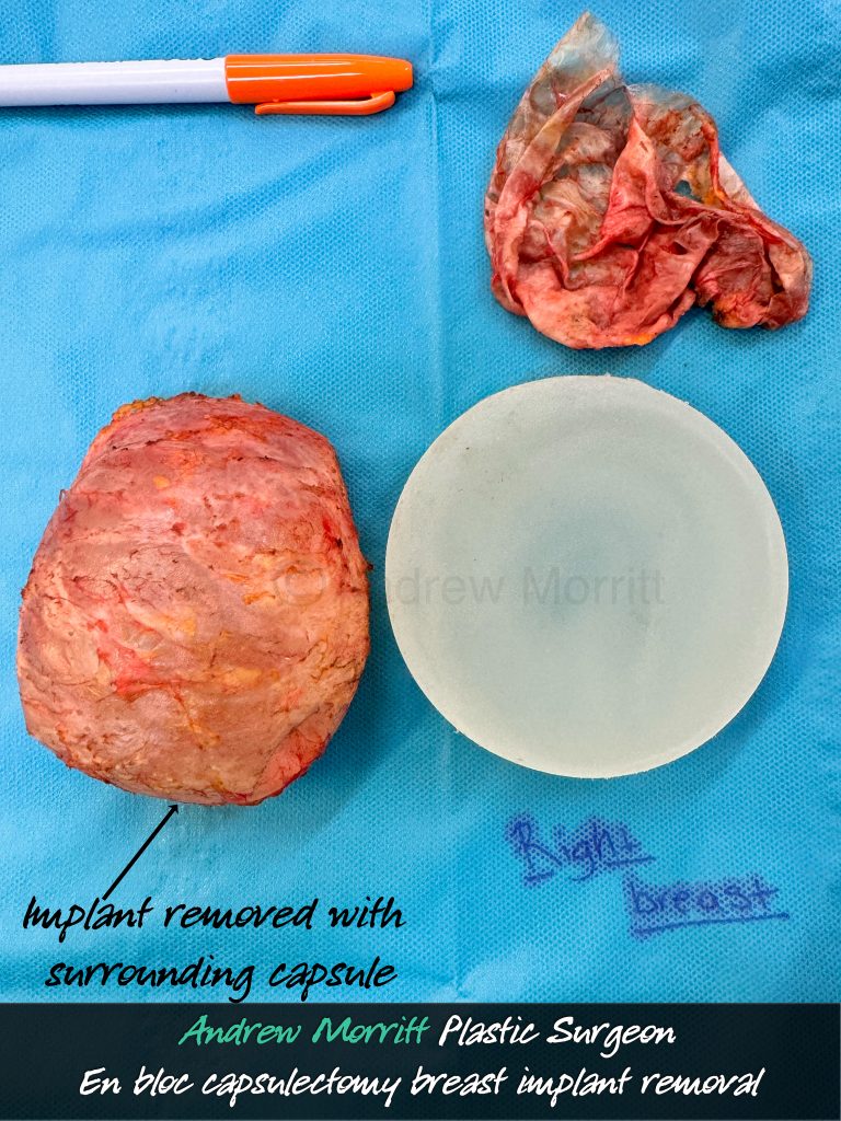 en bloc capsulectomy breast implant removal