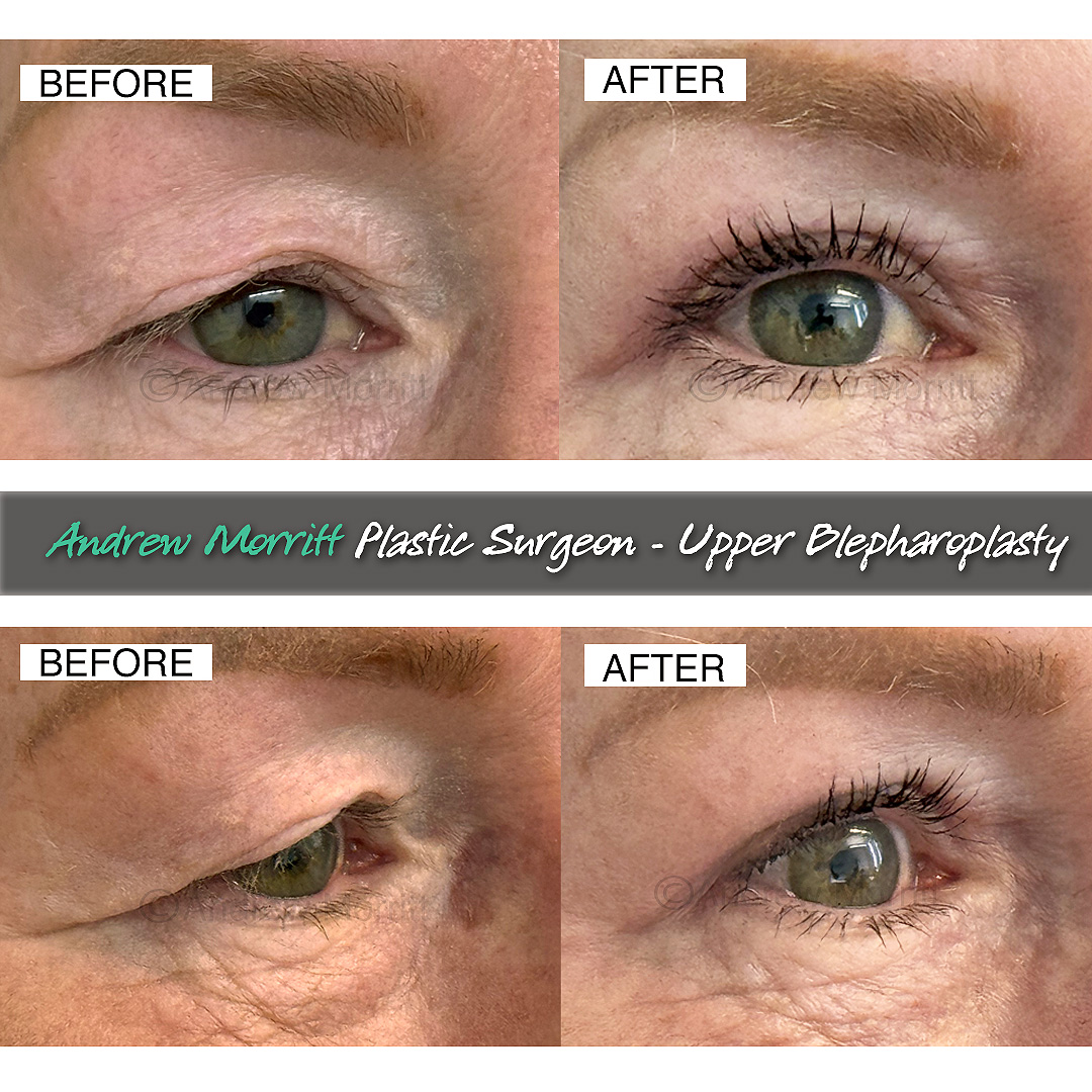 upper eyelid lift blepharoplasty