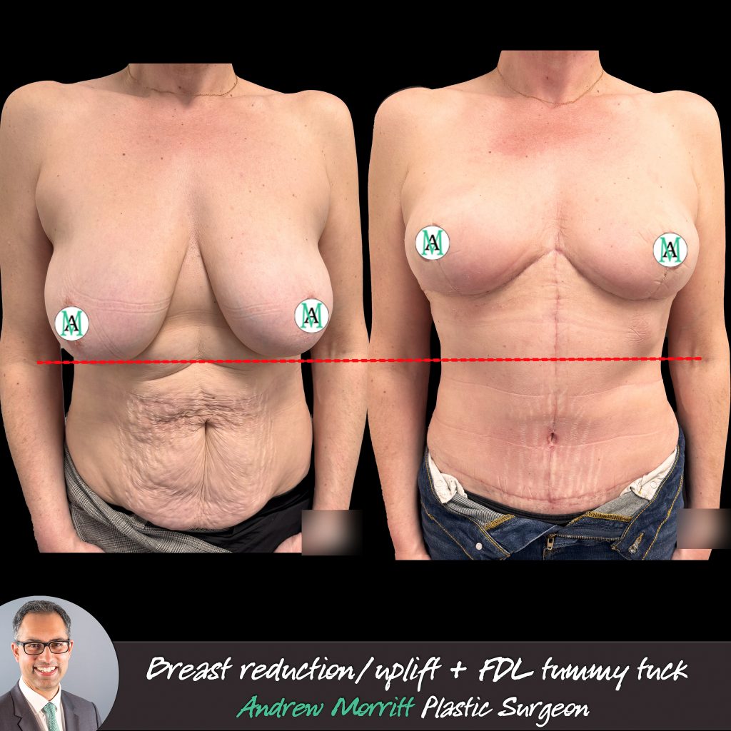 mummy makeover sheffield breast reduction tummy tuck