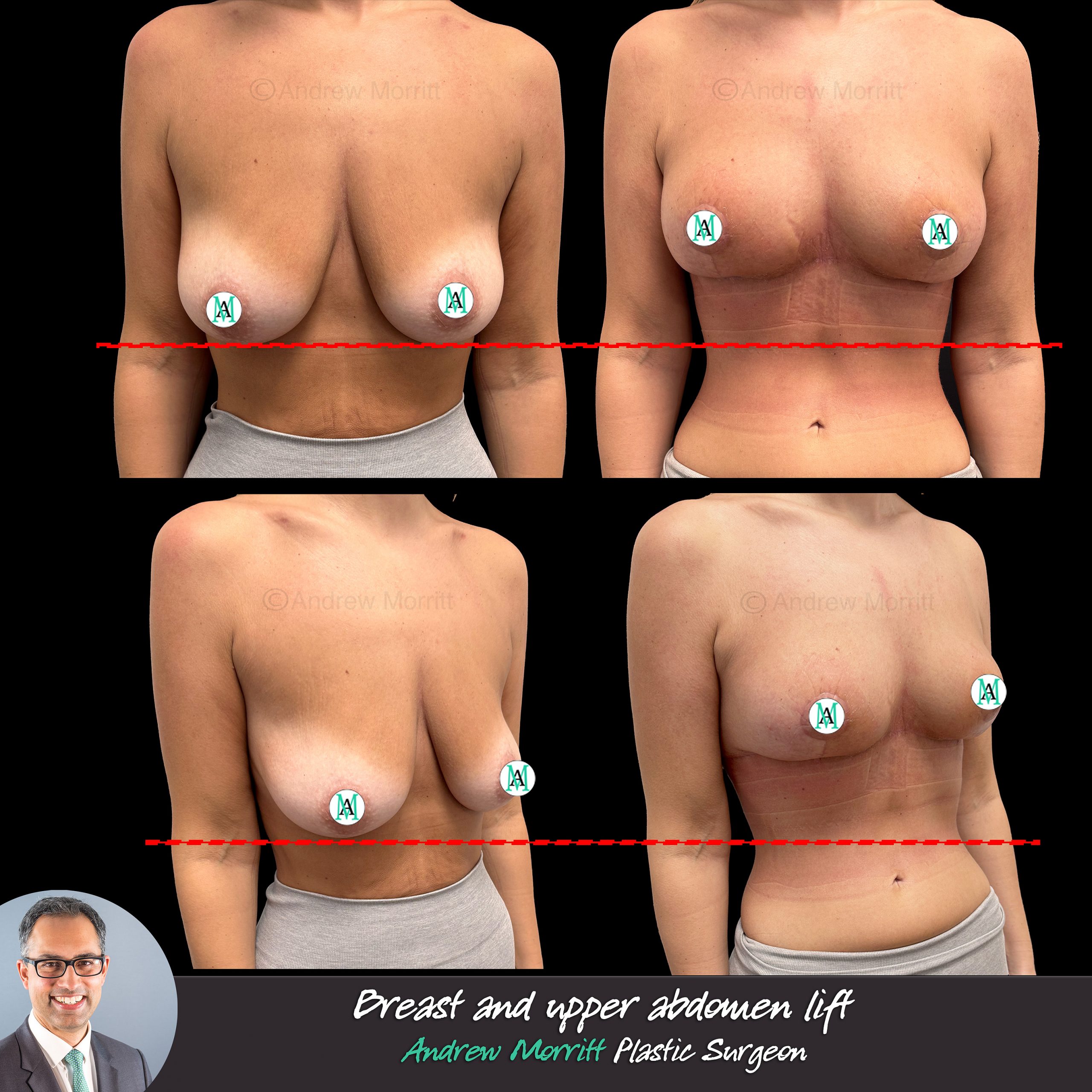 breast uplift reverse tummy tuck