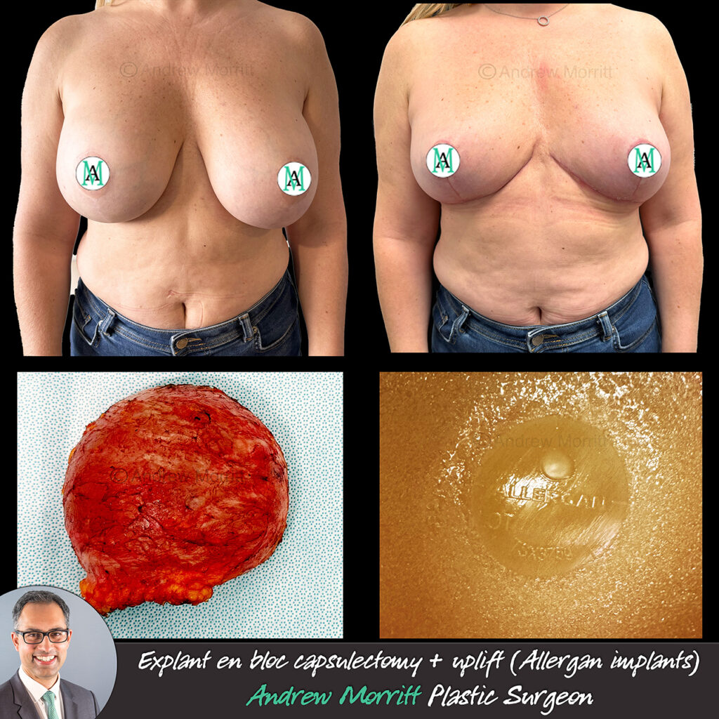 explant allergan implants en bloc capsulectomty uplift