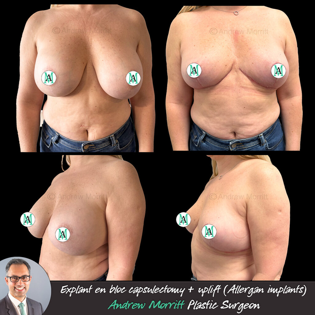 breast implant removal explant allergan uplift