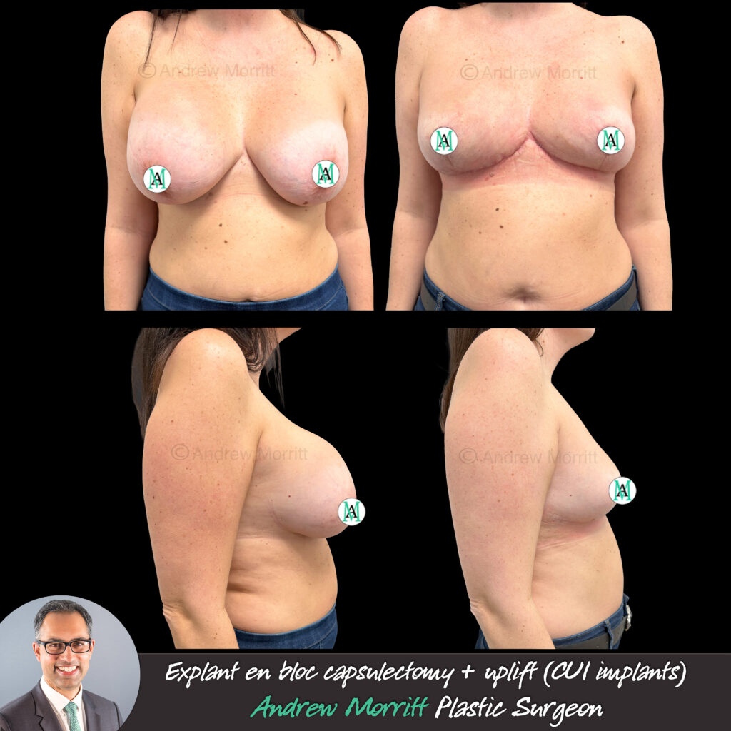 explant uplift CUI implants