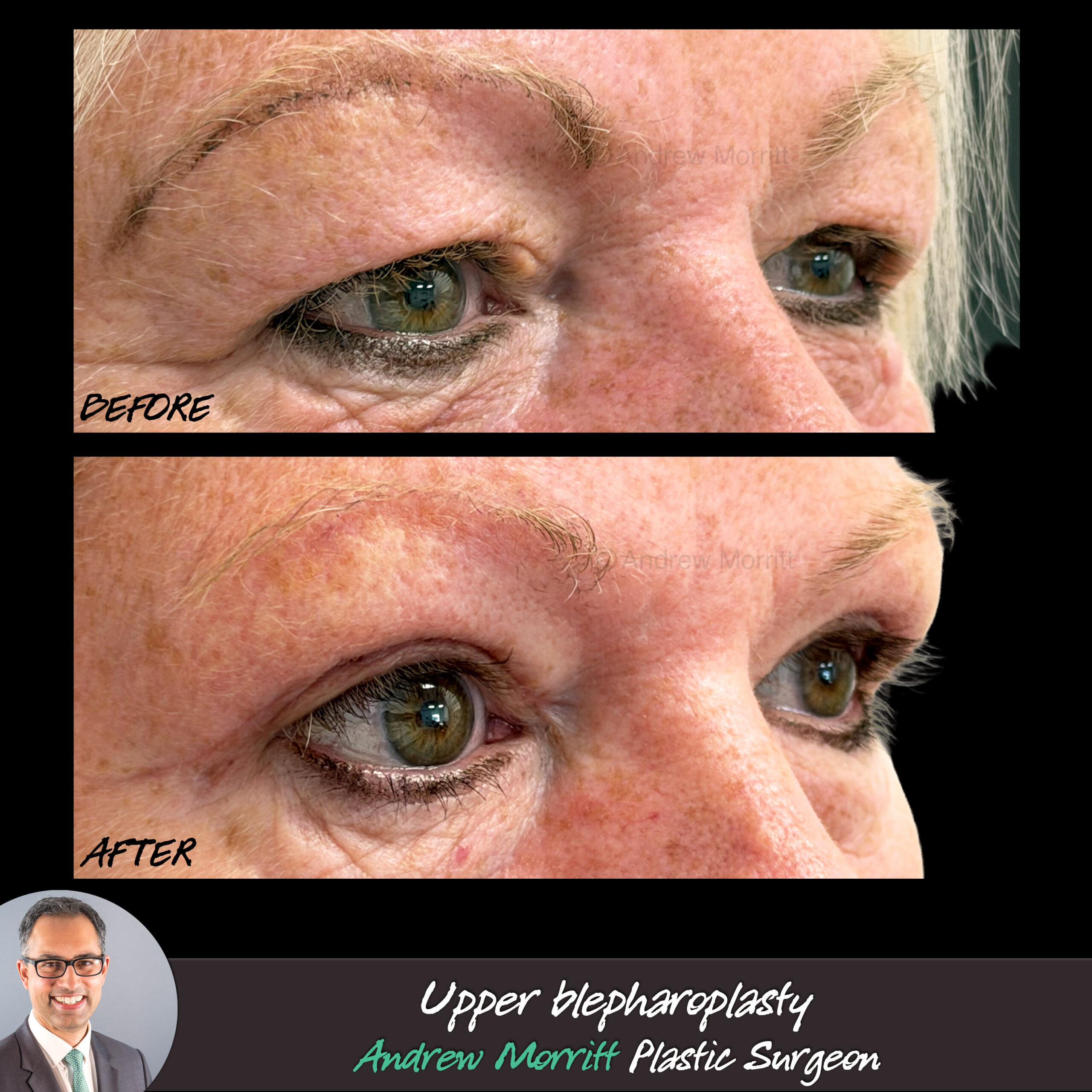 upper blepharoplasty eyelid skin excision outcome
